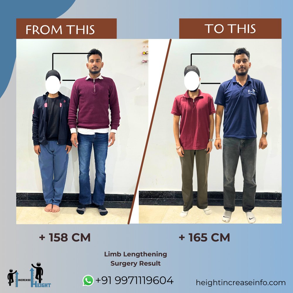 Limb Lengthening Result 1